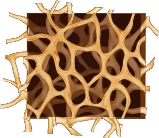 Illustrative diagram of bone showing bone tissue that has become sparse due to reduced bone density