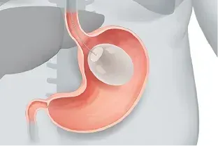 Endball Gastric Balloon Procedure — Original Illustration 2