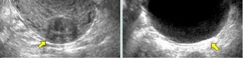 Lower Abdominal Ultrasound