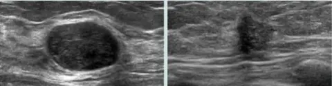 Breast Ultrasound