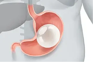 Endball Gastric Balloon Procedure — Original Illustration 3