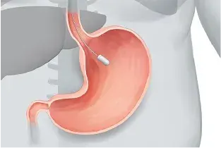 Endball Gastric Balloon Procedure — Original Illustration 1