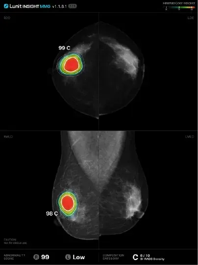Mammography Image