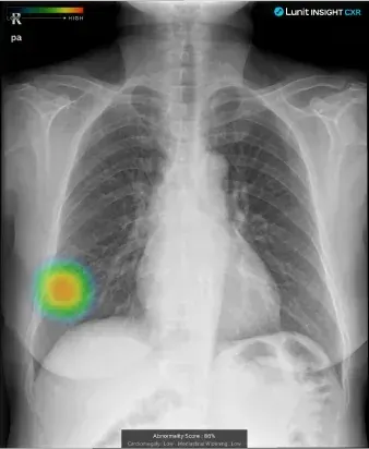 Chest X-ray Image 1