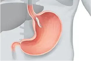 Endball Gastric Balloon Procedure — Original Illustration 4