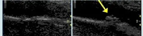 Carotid Artery Ultrasound
