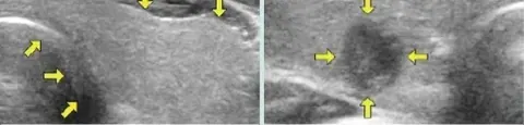 Thyroid Ultrasound