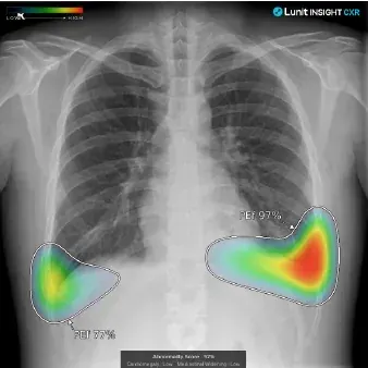 Chest X-ray Image 2