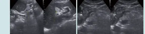 Upper Abdominal Ultrasound