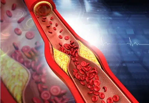 Hyperlipidemia